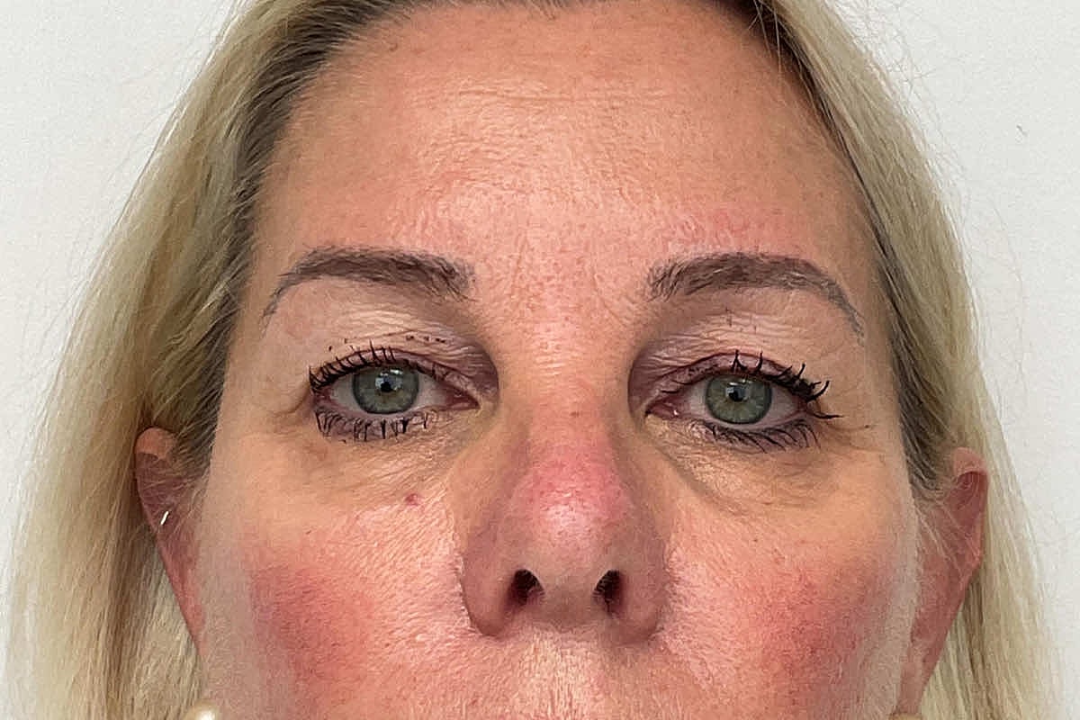 Blepharoplasty Eyelid Surgery Before & After