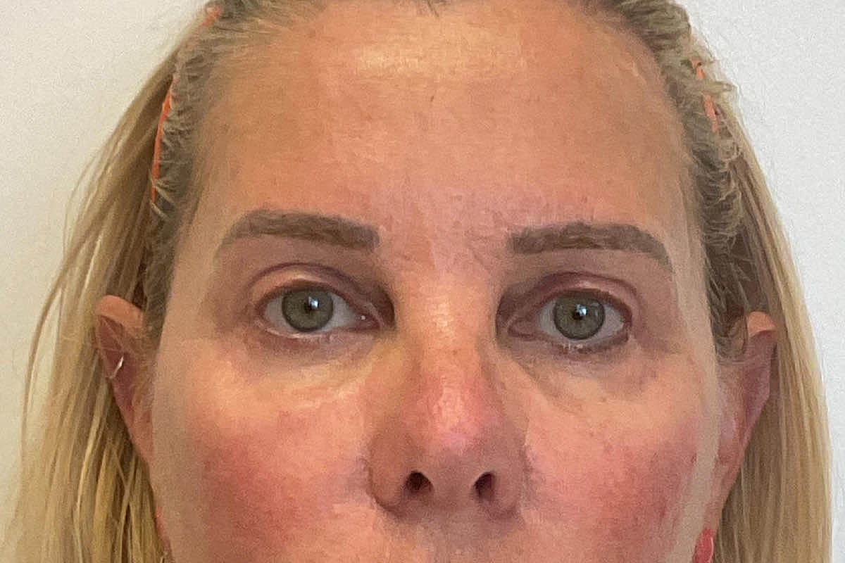 Blepharoplasty Eyelid Surgery Before & After