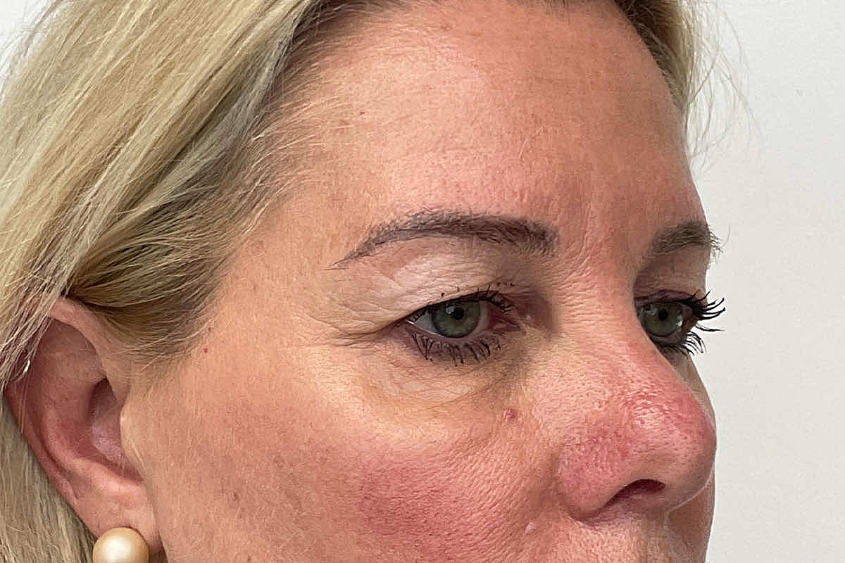 Blepharoplasty Eyelid Surgery Before & After
