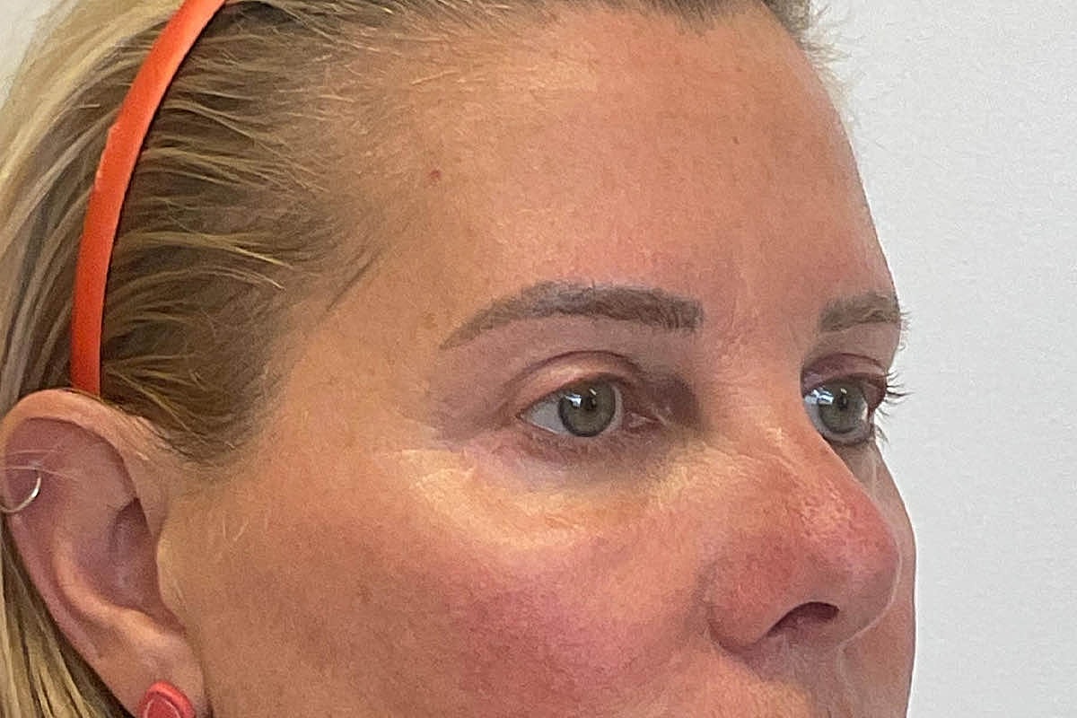 Blepharoplasty Eyelid Surgery Before & After