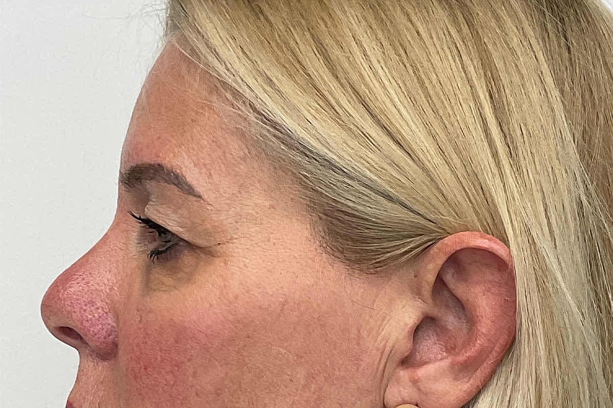 Blepharoplasty Eyelid Surgery Before & After