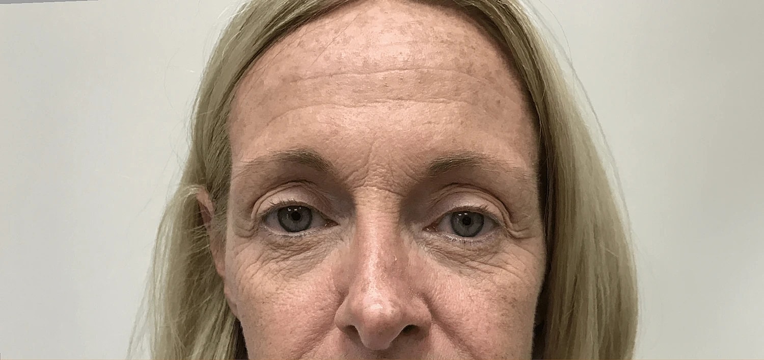 Blepharoplasty Eyelid Surgery Before & After