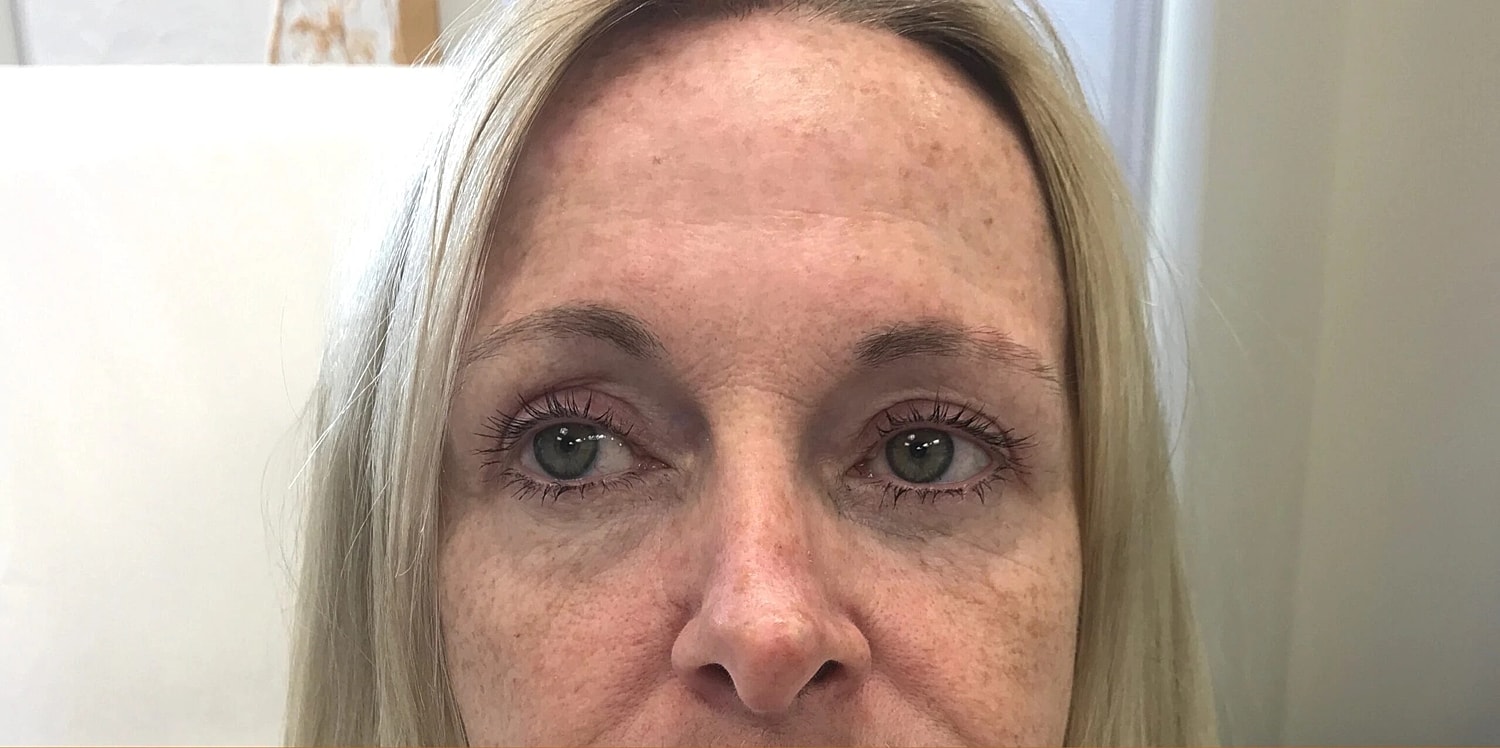 Blepharoplasty Eyelid Surgery Before & After