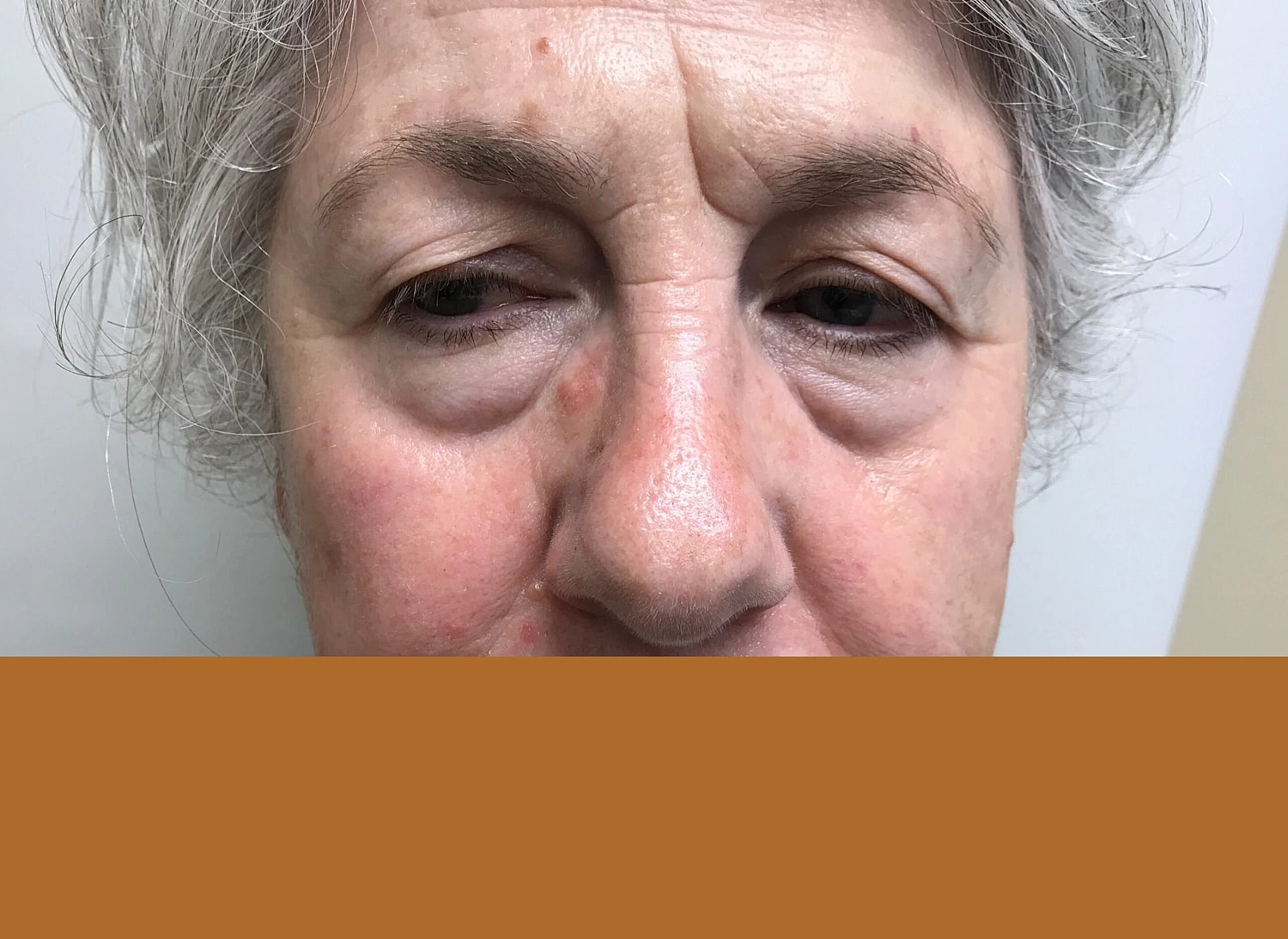 Blepharoplasty Eyelid Surgery Before & After