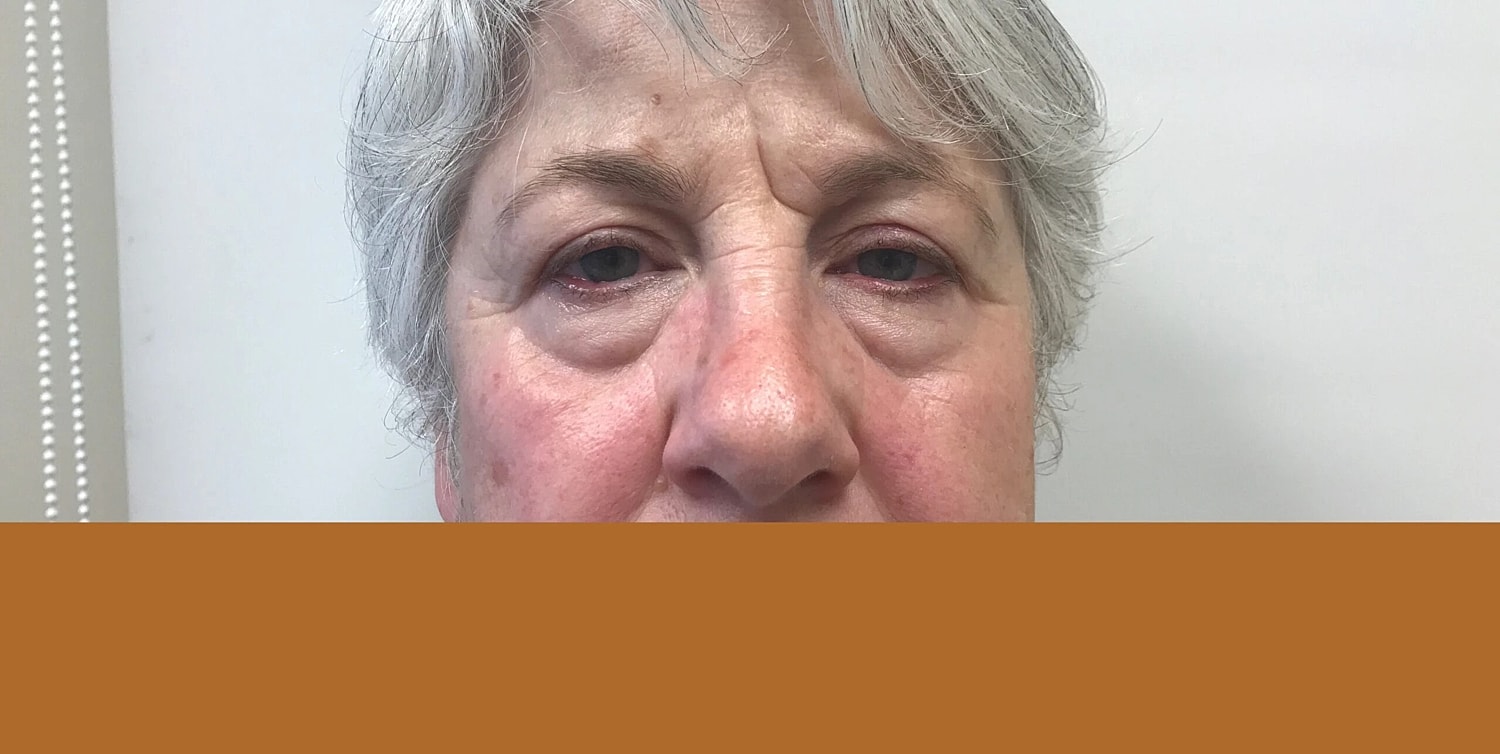 Blepharoplasty Eyelid Surgery Before & After