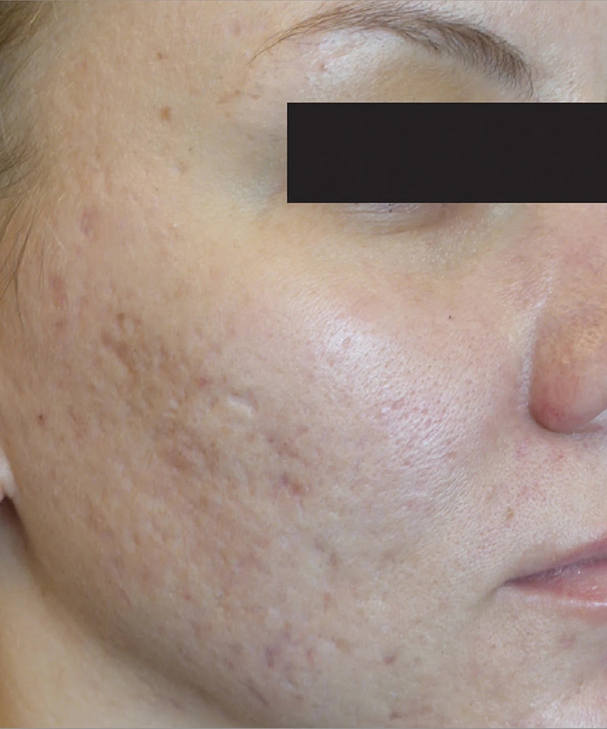 Skin Resurfacing Before & After
