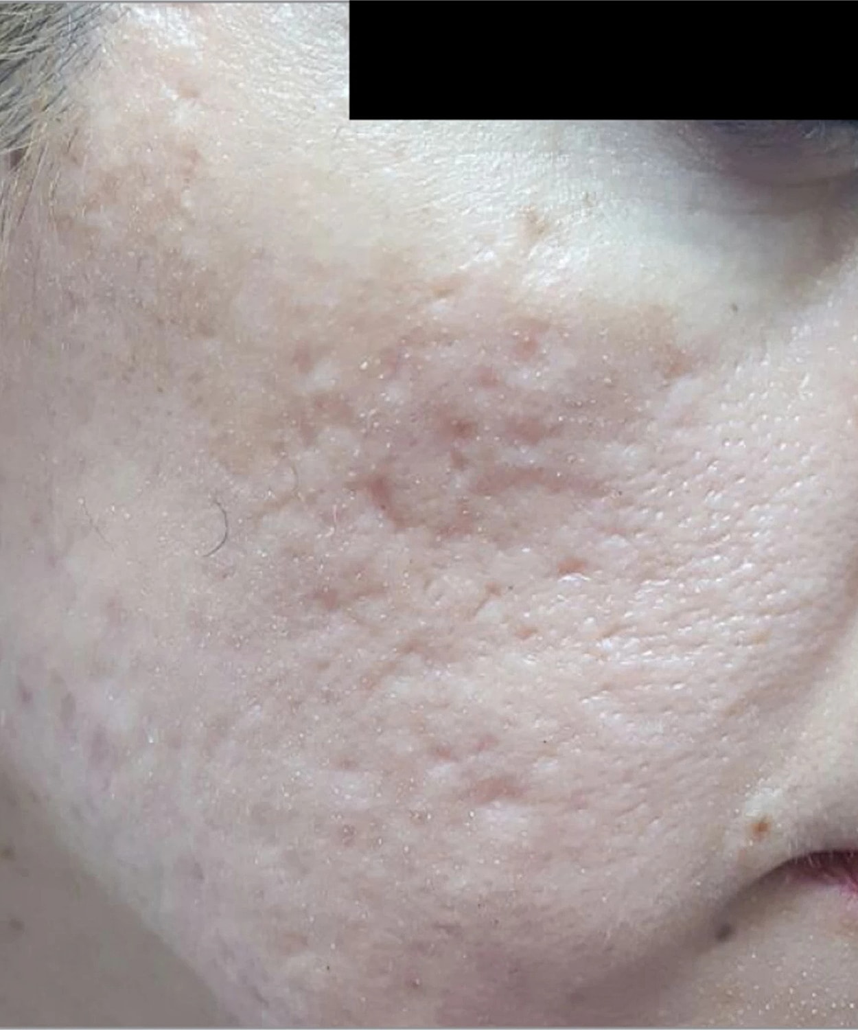 Skin Resurfacing Before & After