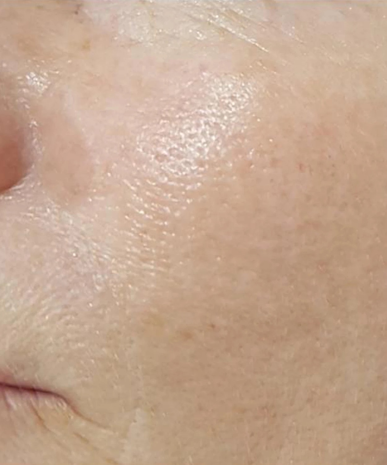 Ipl Before & After