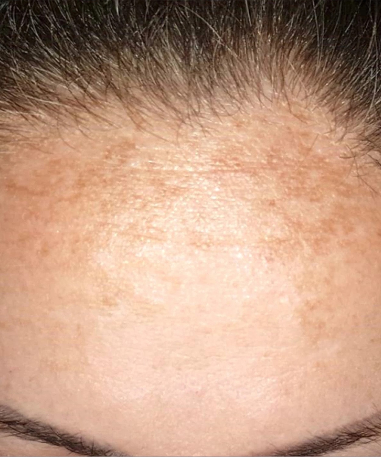 Ipl Before & After