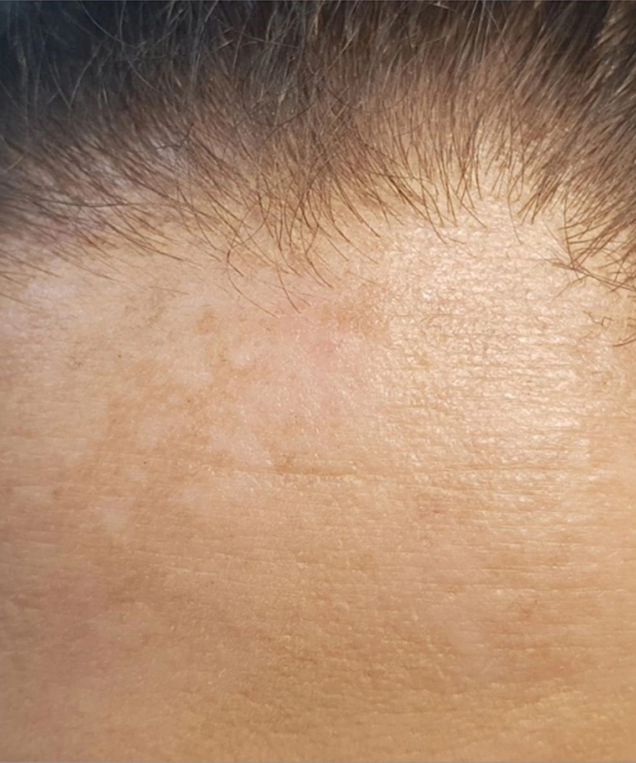Ipl Before & After