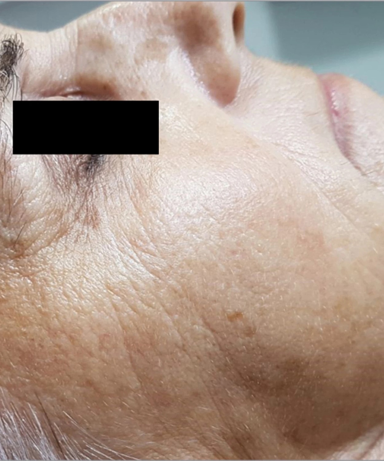 Ipl Before & After