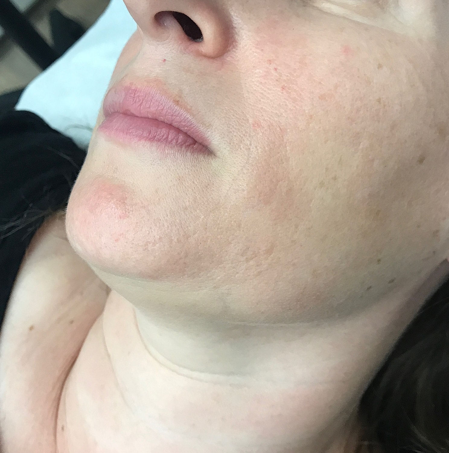 Dermal Fillers Before & After