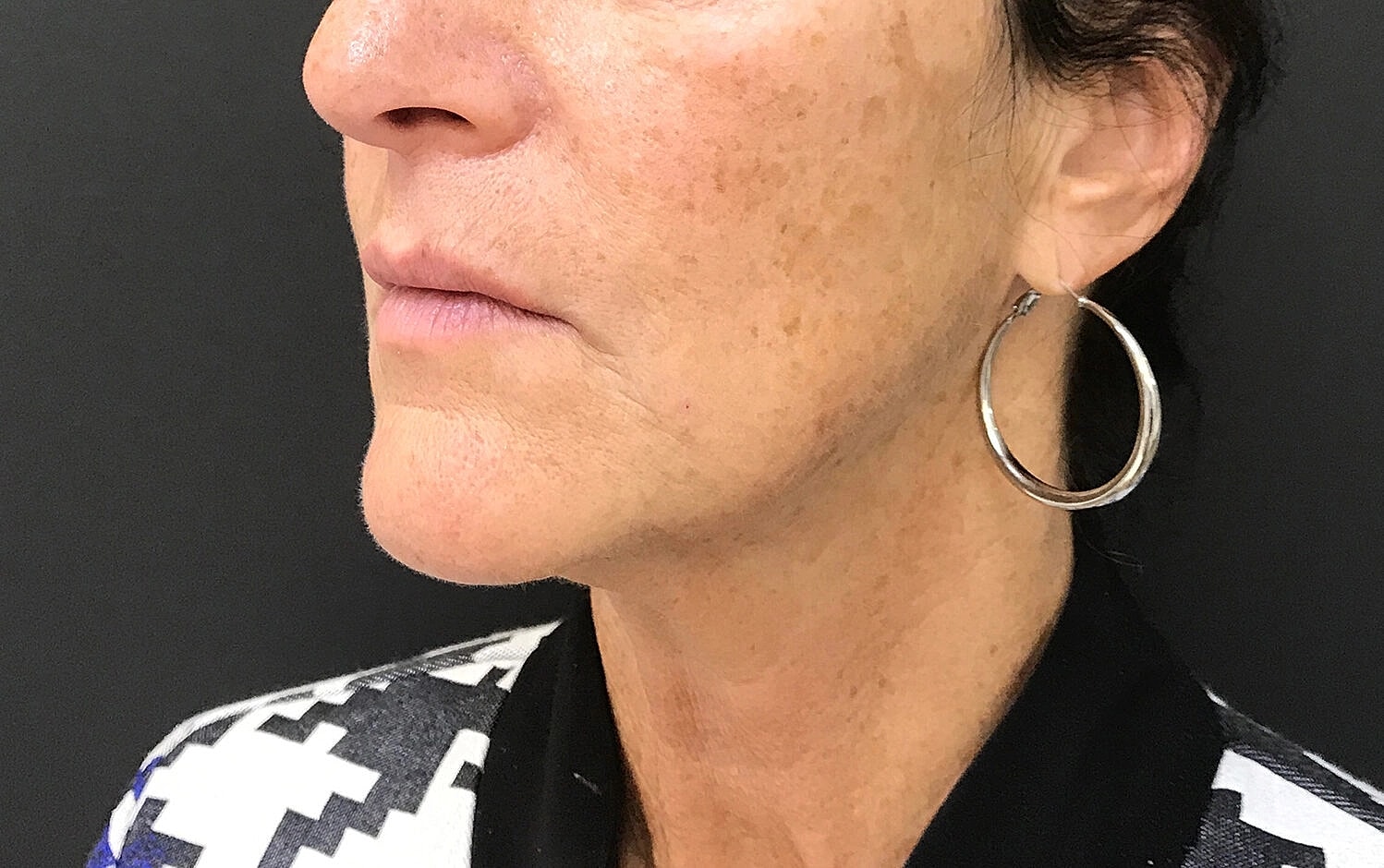 Dermal Fillers Before & After
