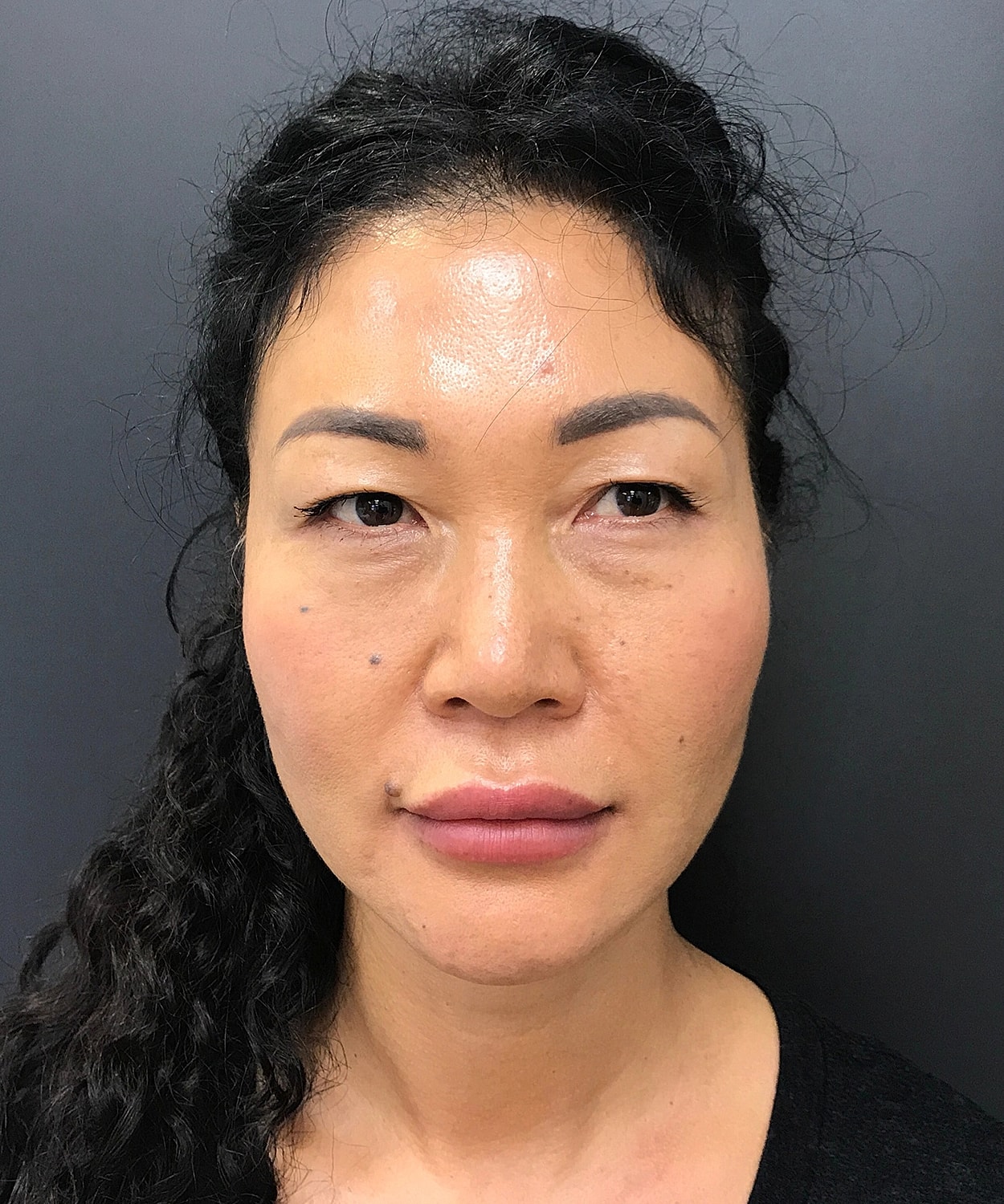 Dermal Fillers Before & After