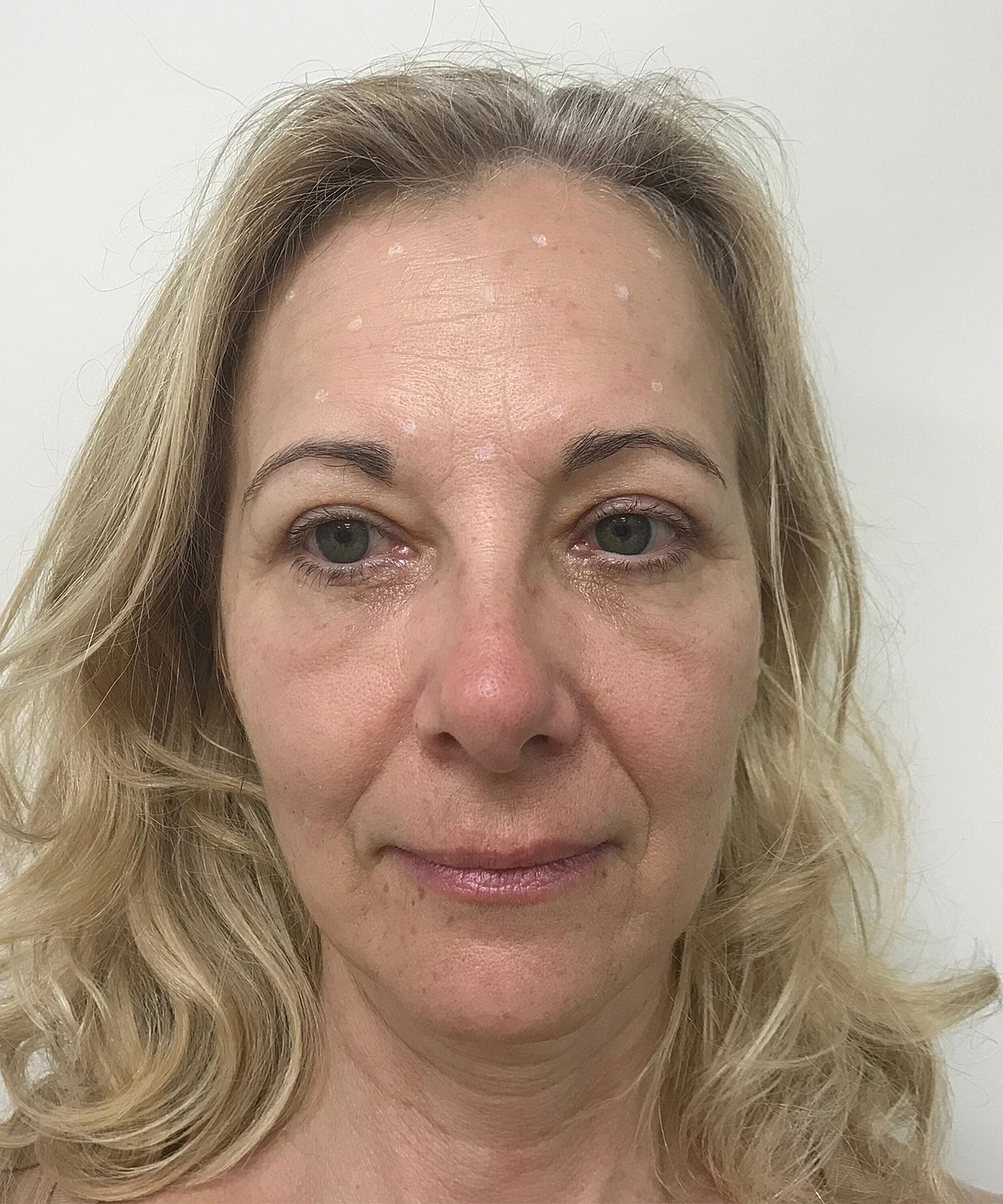 Dermal Fillers Before & After