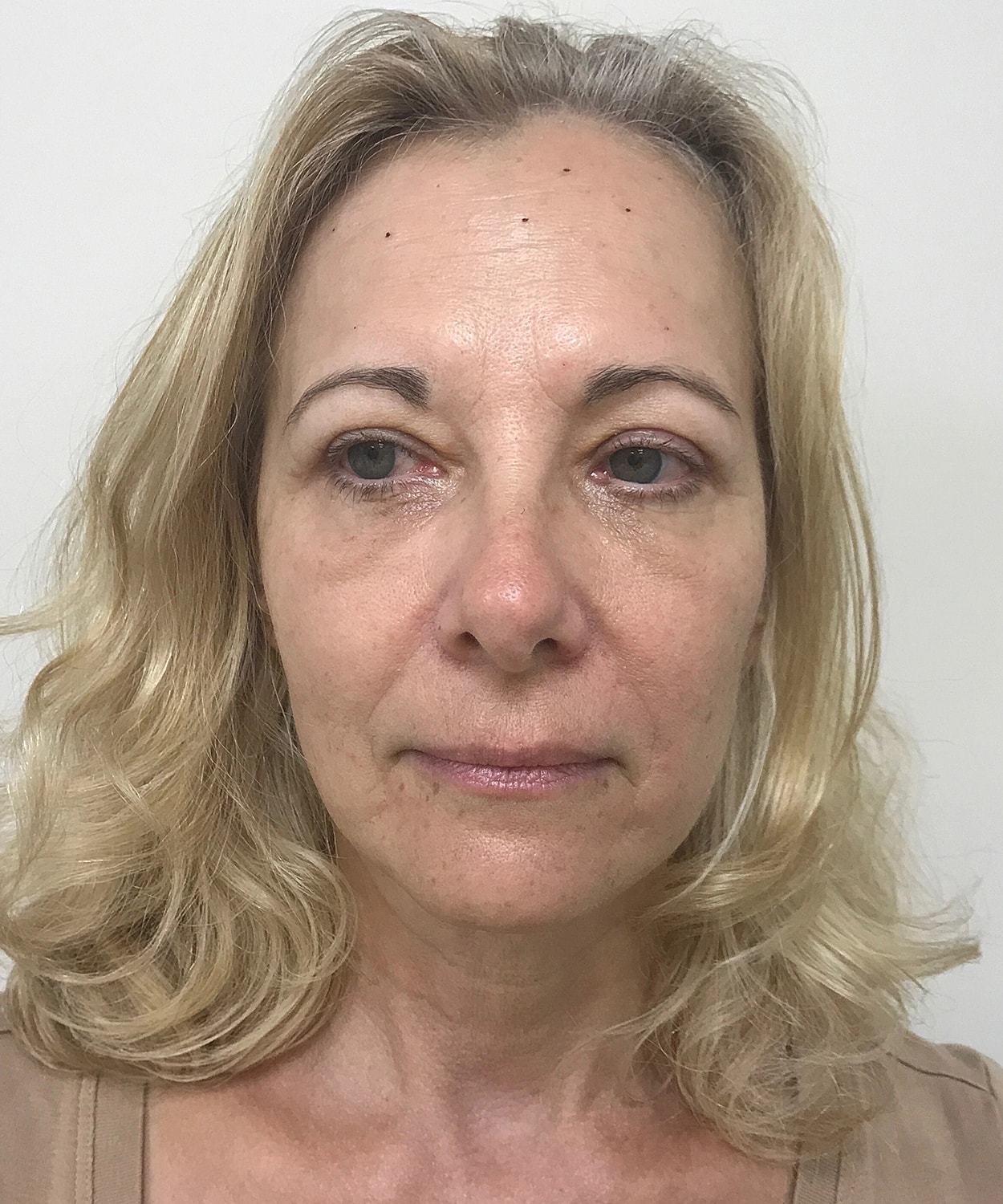 Dermal Fillers Before & After