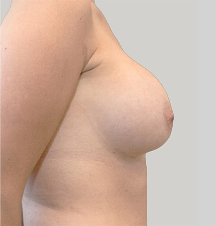 Breast Augmentation Before & After