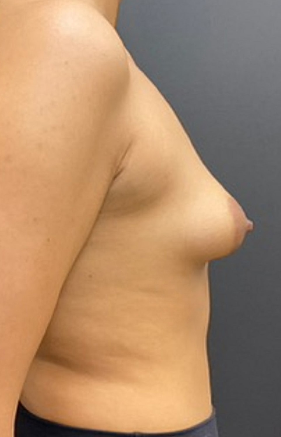 Breast Augmentation Before & After