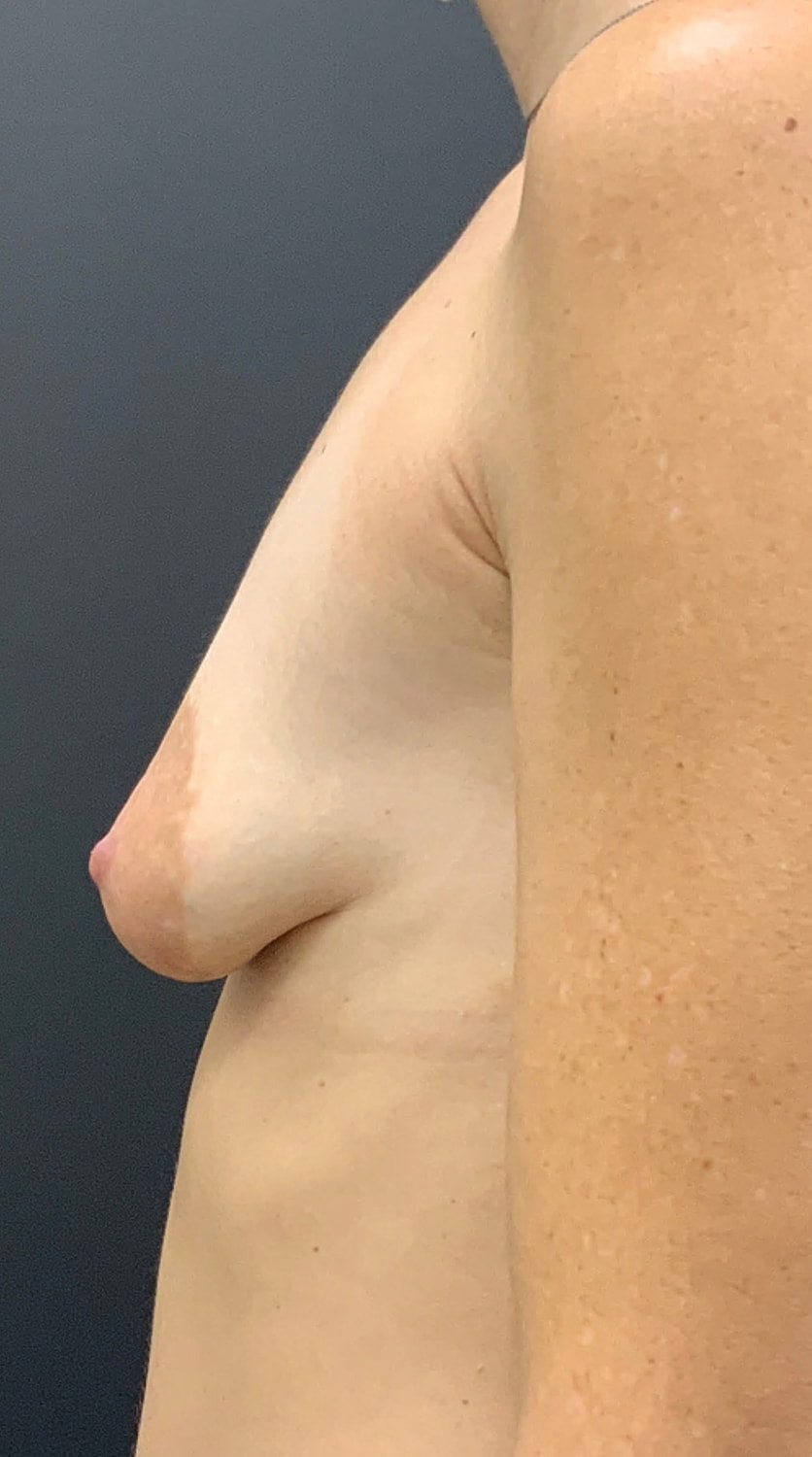 Breast Augmentation Before & After