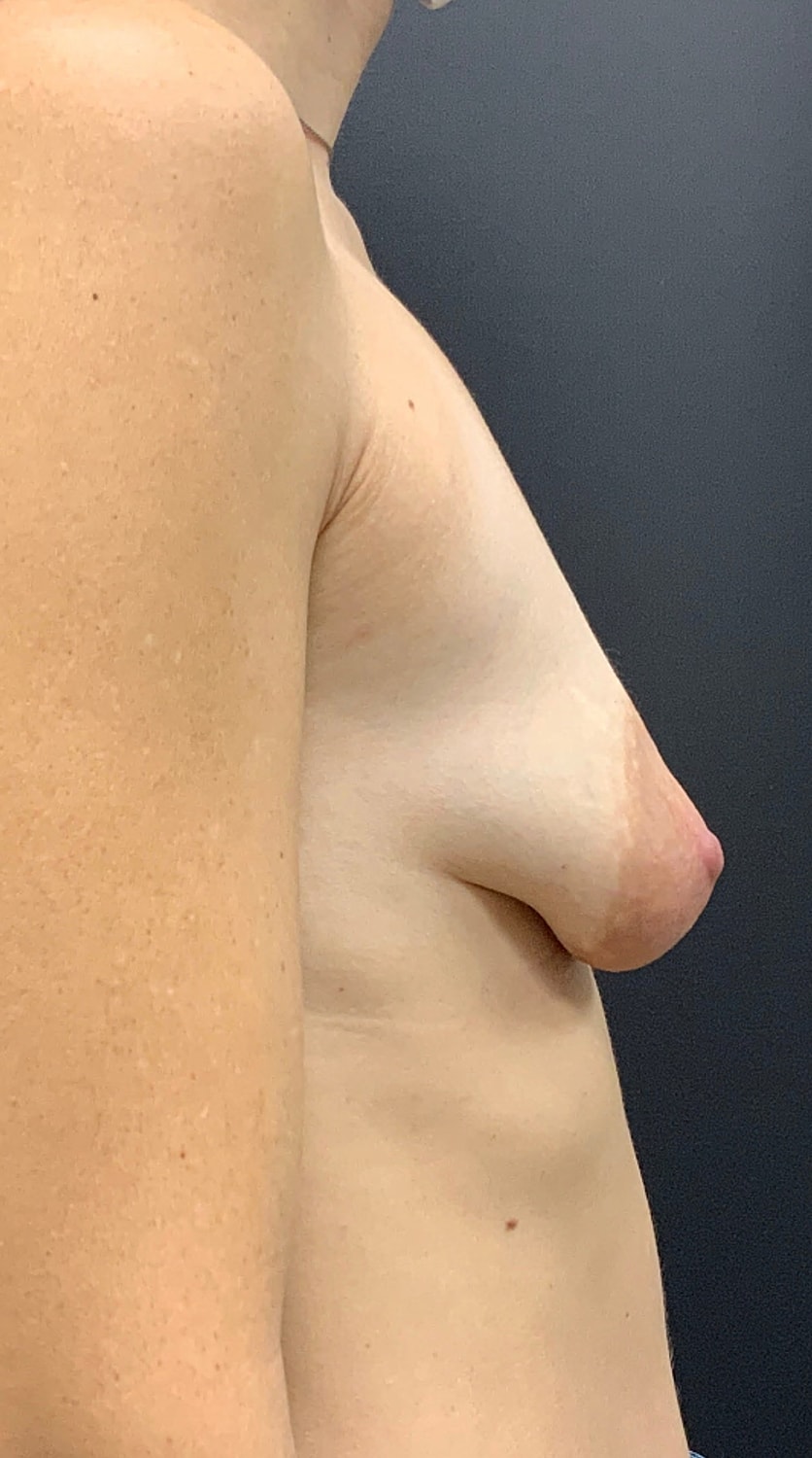 Breast Augmentation Before & After