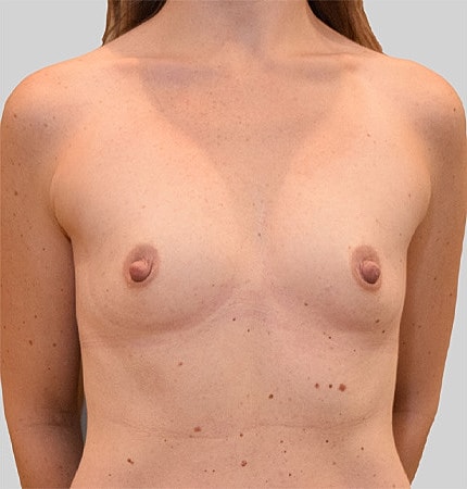 Breast Augmentation Before & After