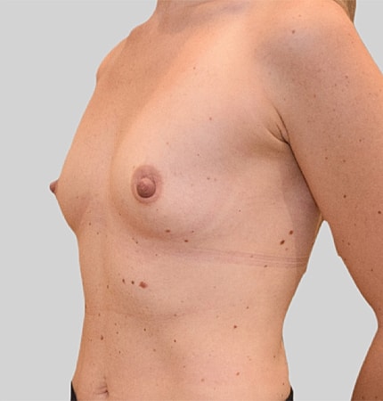 Breast Augmentation Before & After