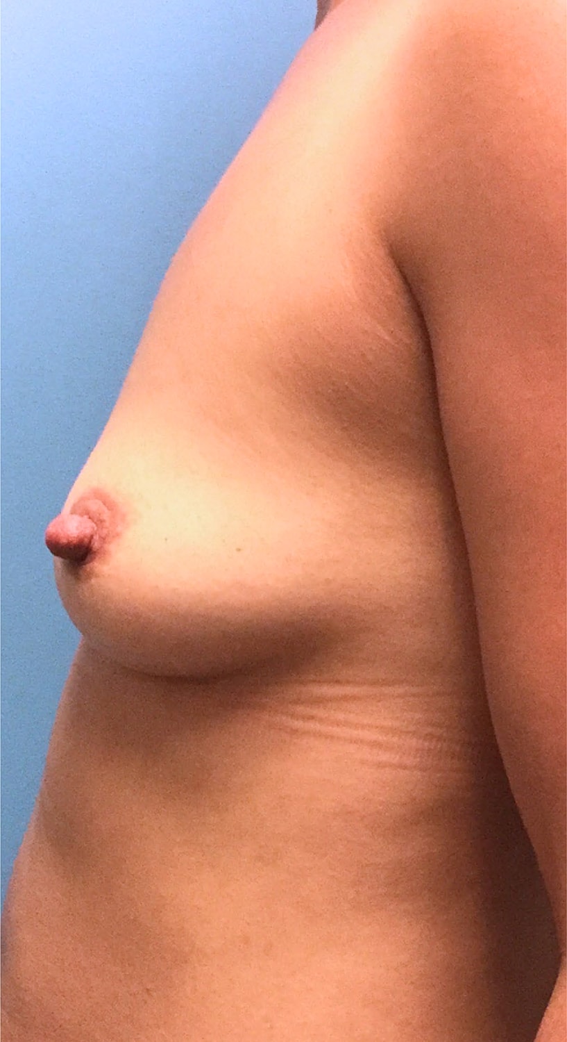 Breast Augmentation Before & After