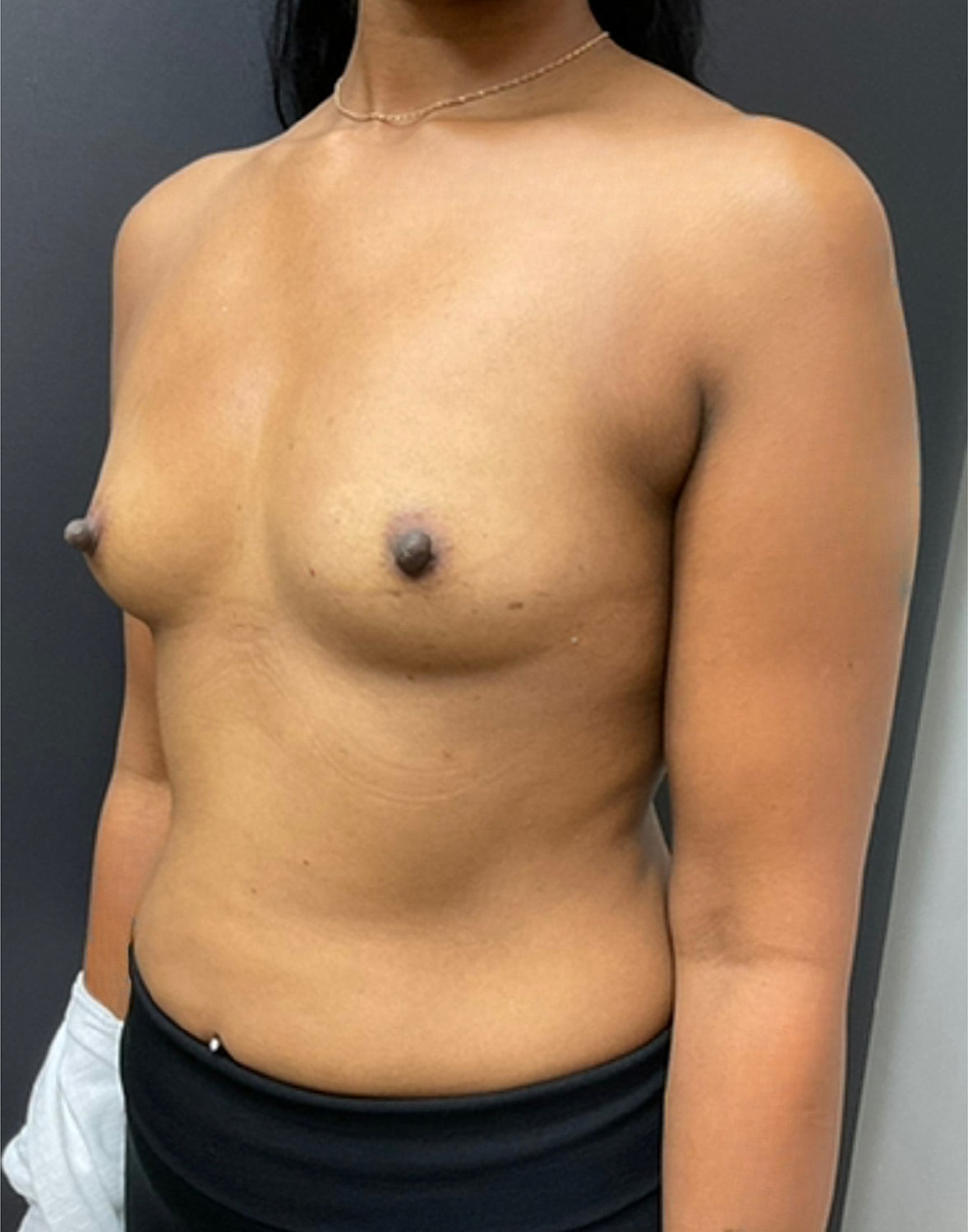 Breast Augmentation Before & After