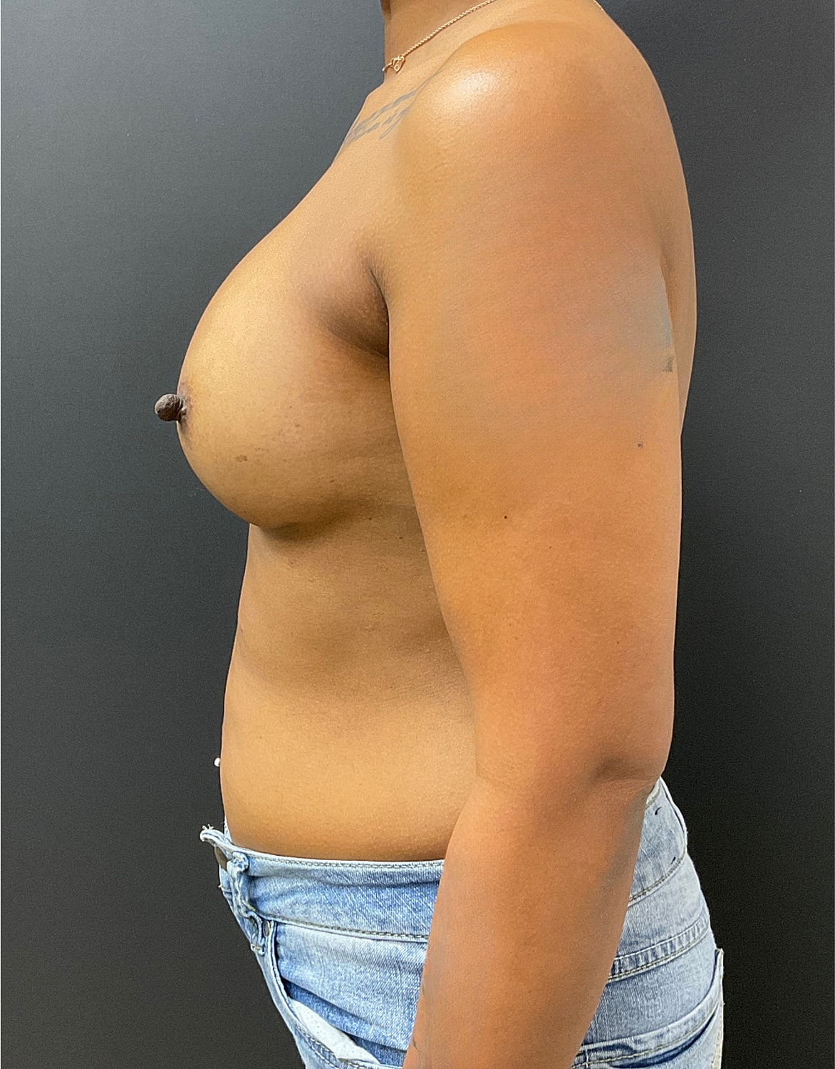 Breast Augmentation Before & After