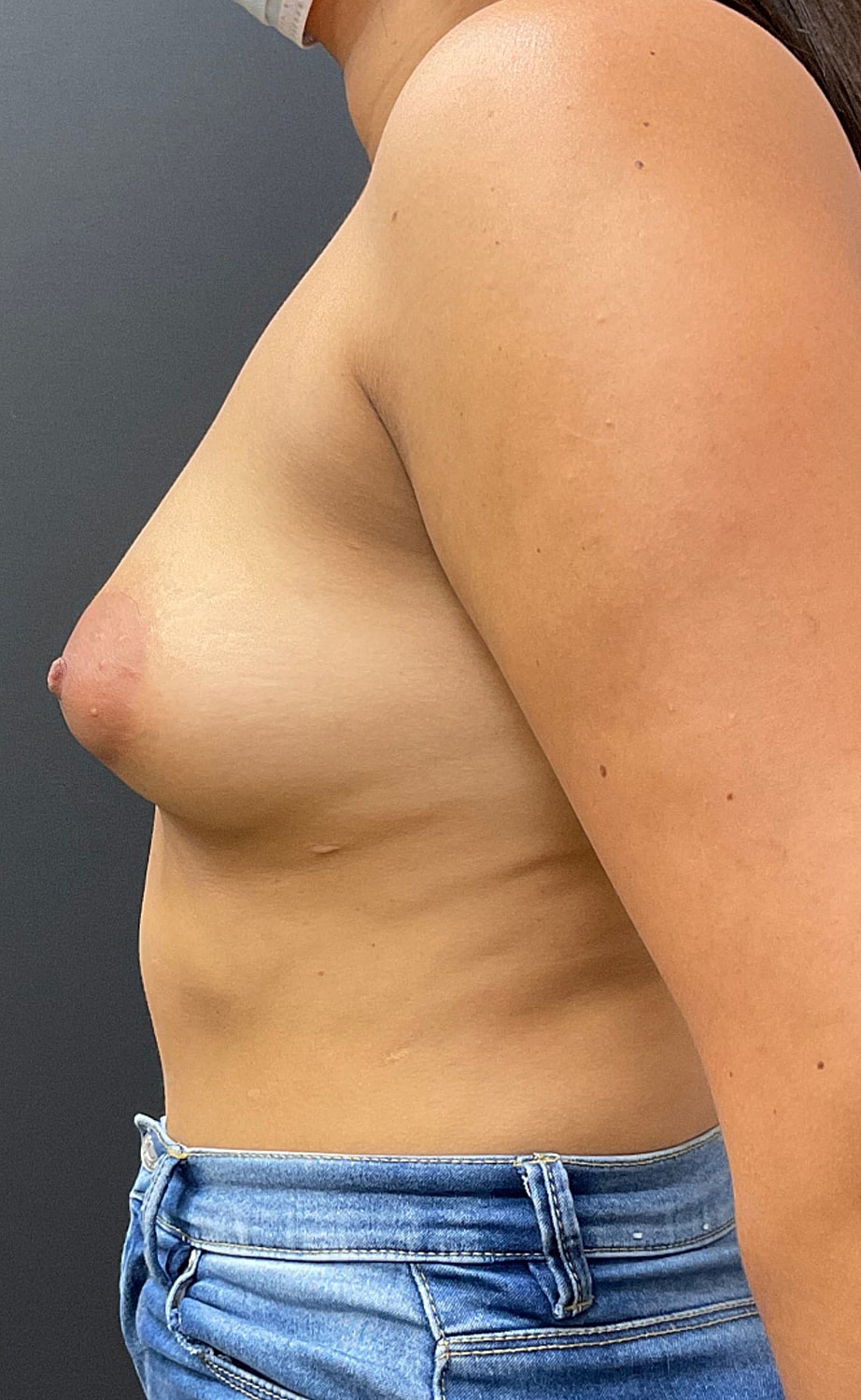 Breast Augmentation Before & After