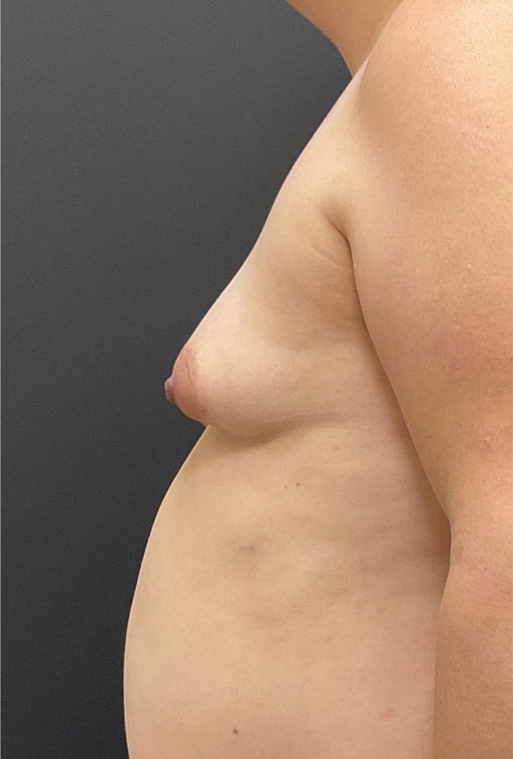 Breast Augmentation Before & After