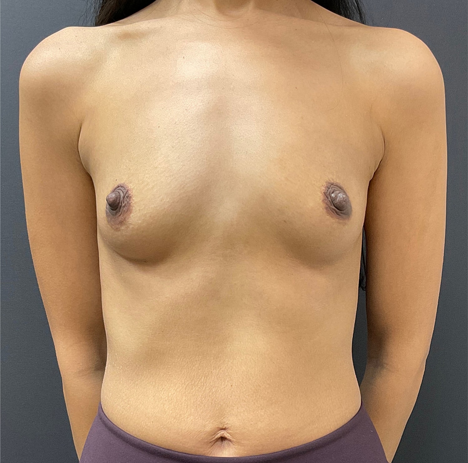 Breast Augmentation Before & After