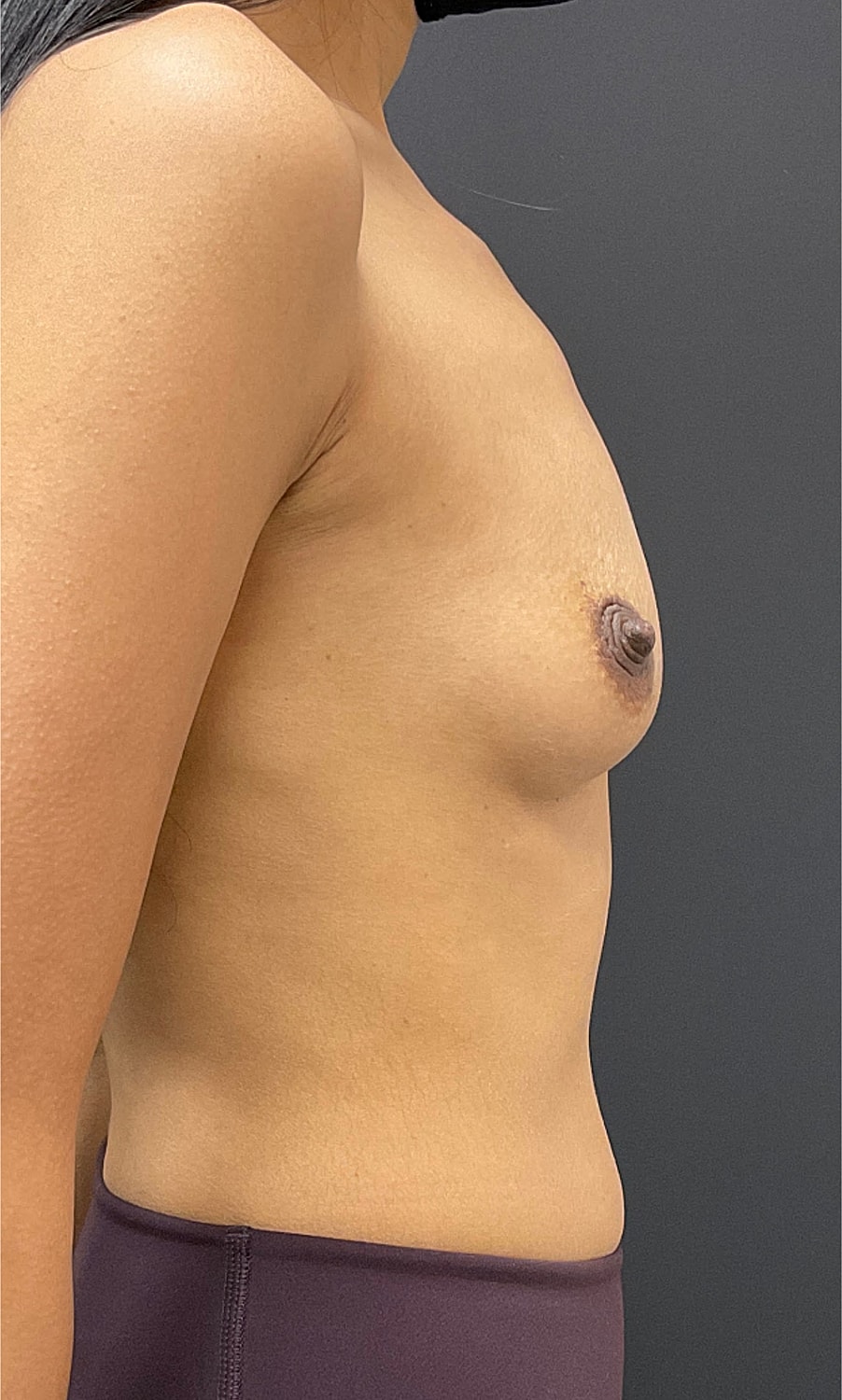 Breast Augmentation Before & After
