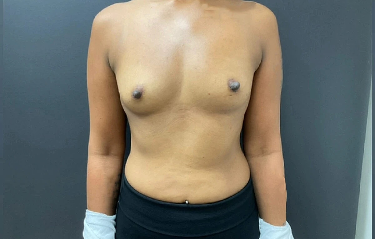 Breast Augmentation Before & After