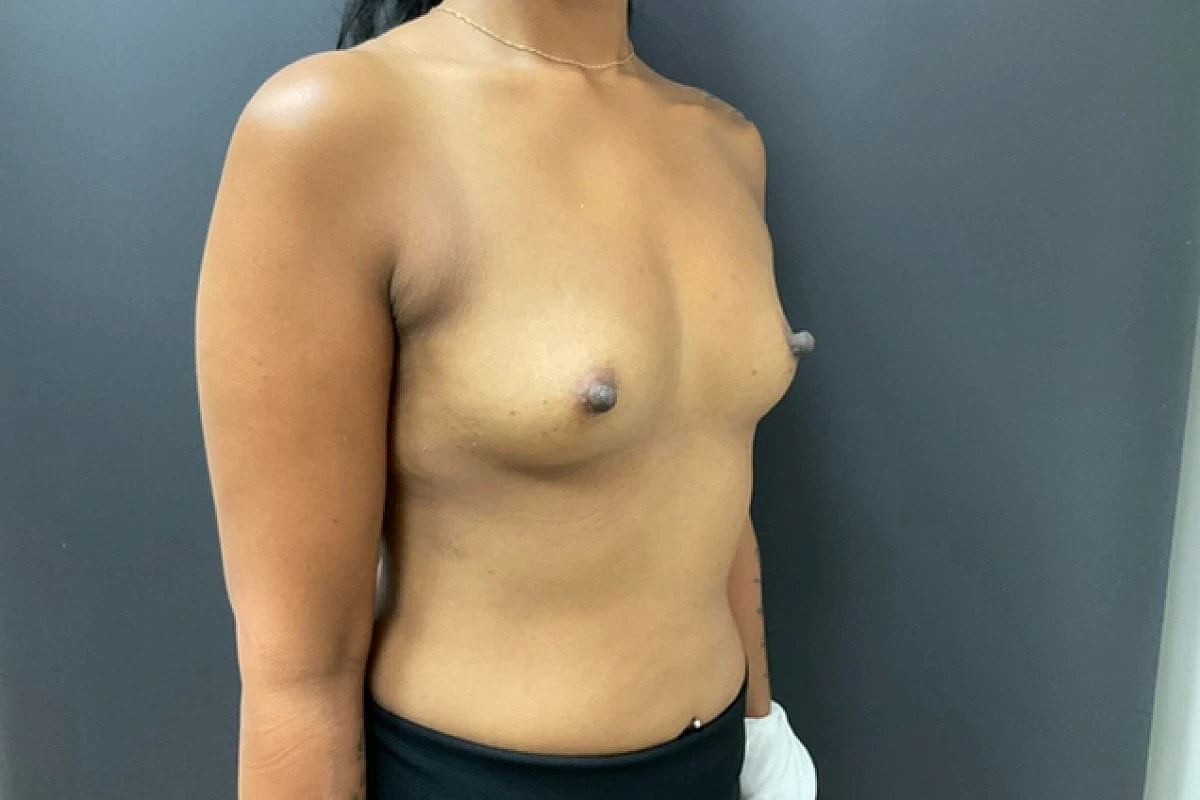 Breast Augmentation Before & After