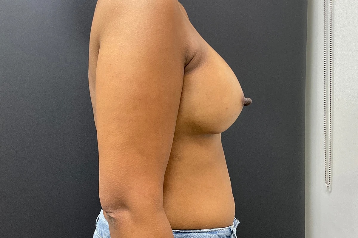 Breast Augmentation Before & After