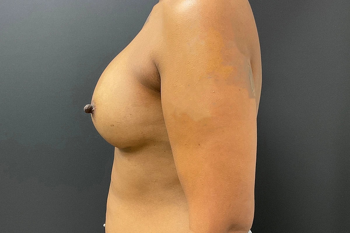 Breast Augmentation Before & After