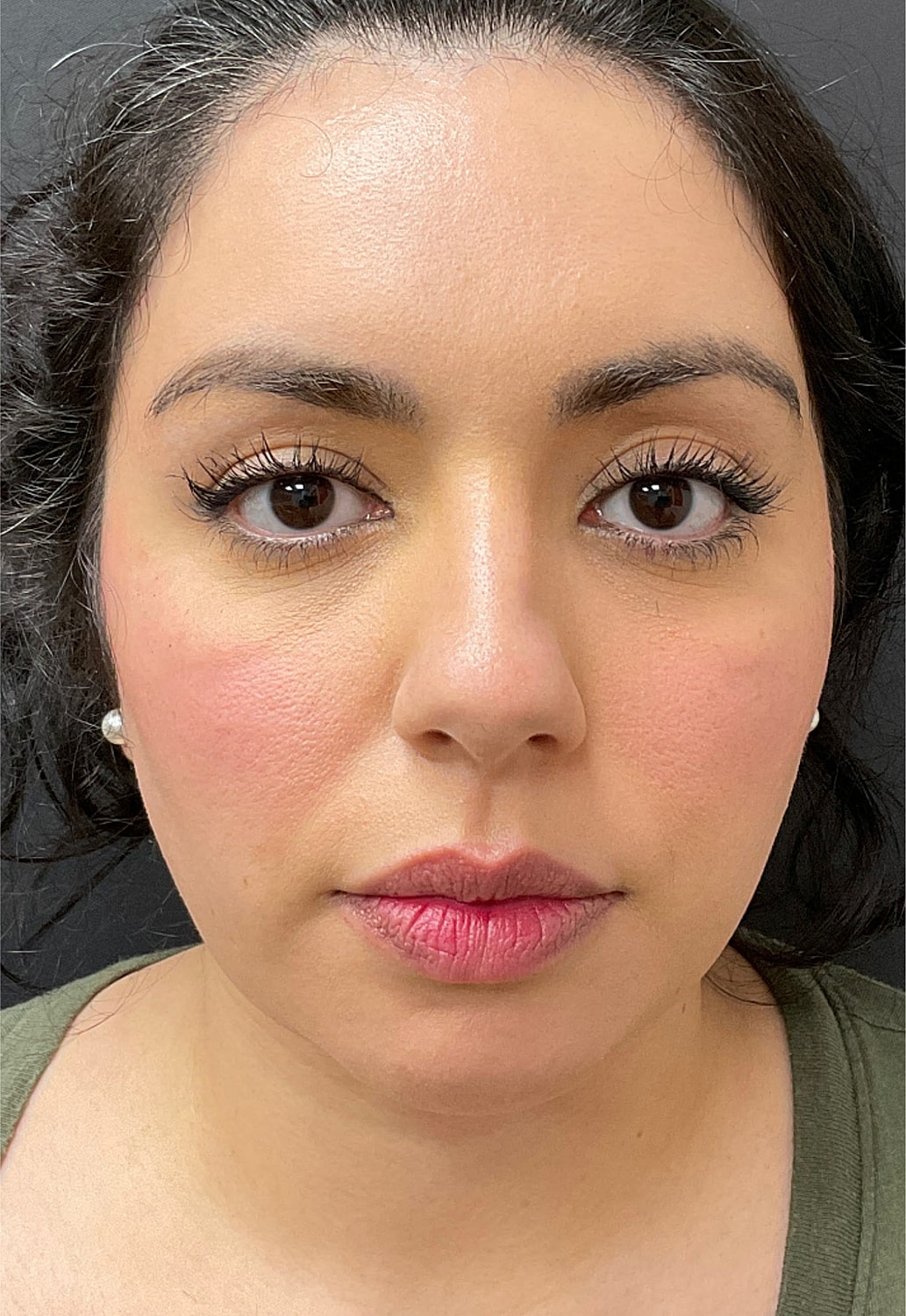 Chin Jawline Before & After