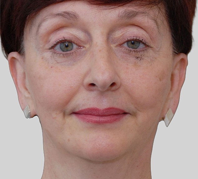 Chin Jawline Before & After
