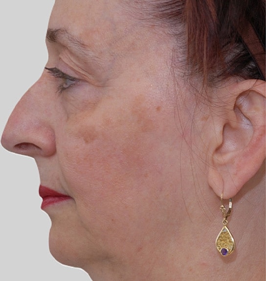 Chin Jawline Before & After