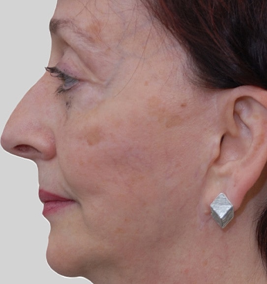 Chin Jawline Before & After