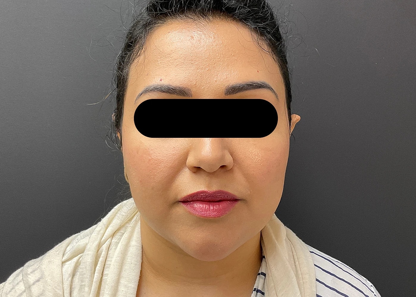 Chin Jawline Before & After