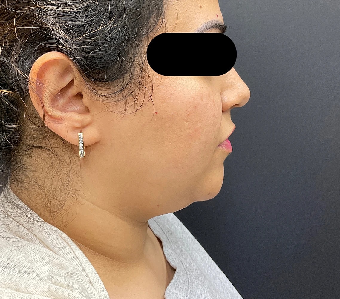 Chin Jawline Before & After