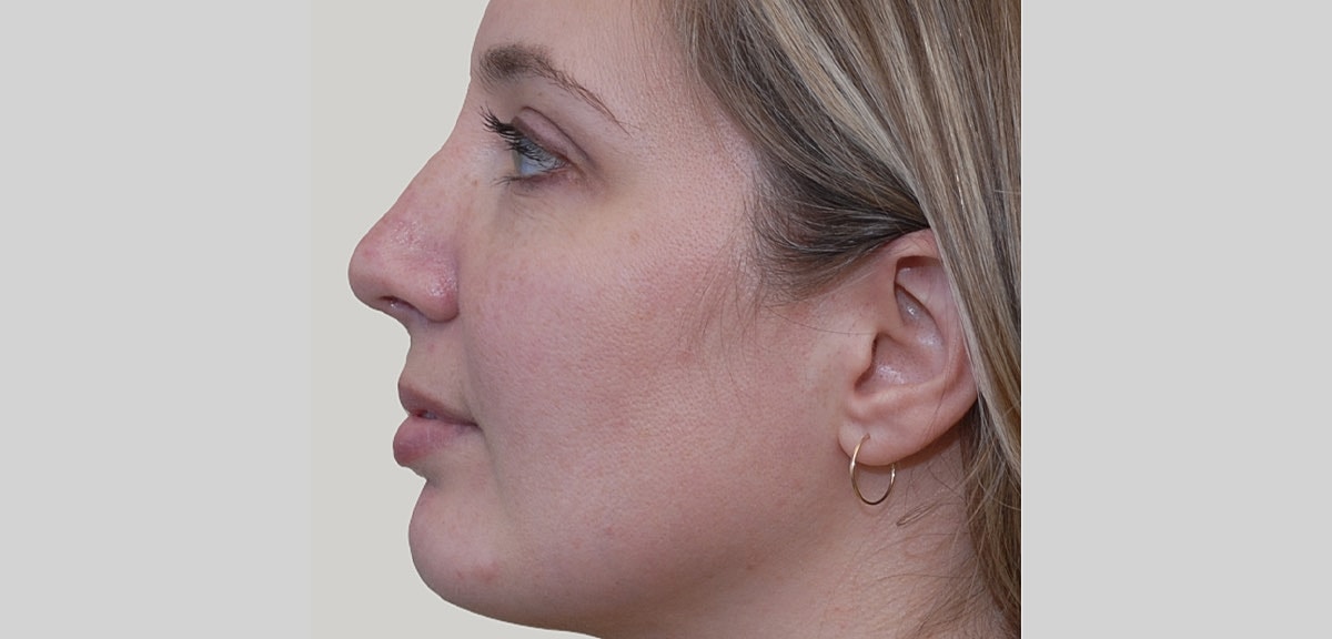 Chin Jawline Before & After