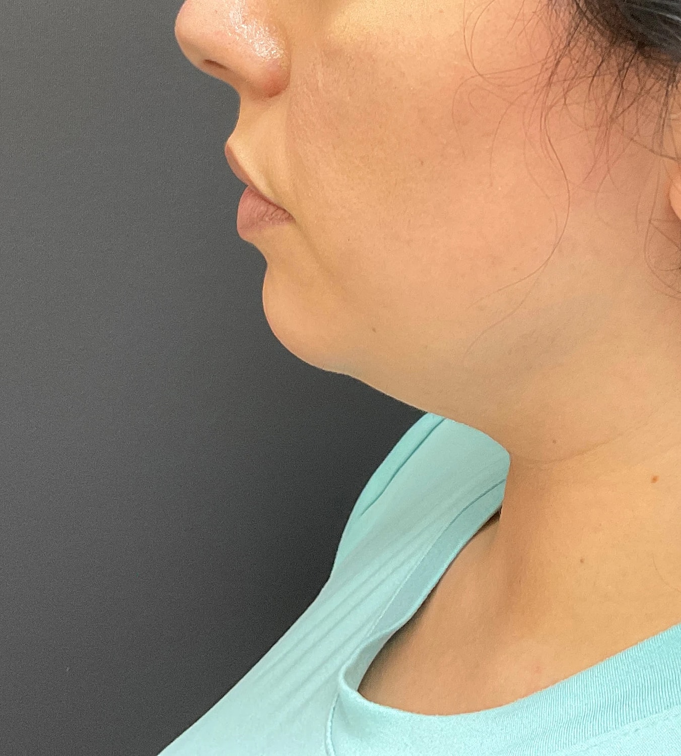Chin Jawline Before & After