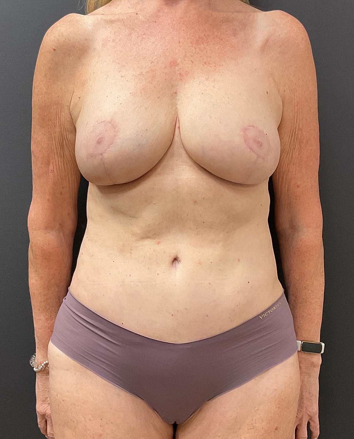 Breast Reduction Before & After