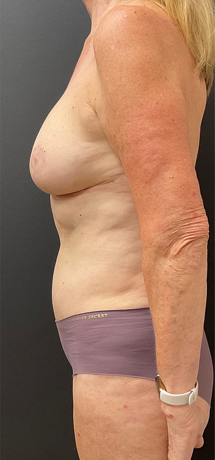Breast Reduction Before & After
