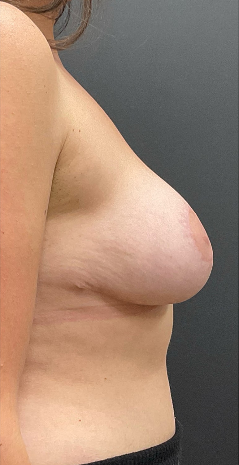 Breast Reduction Before & After