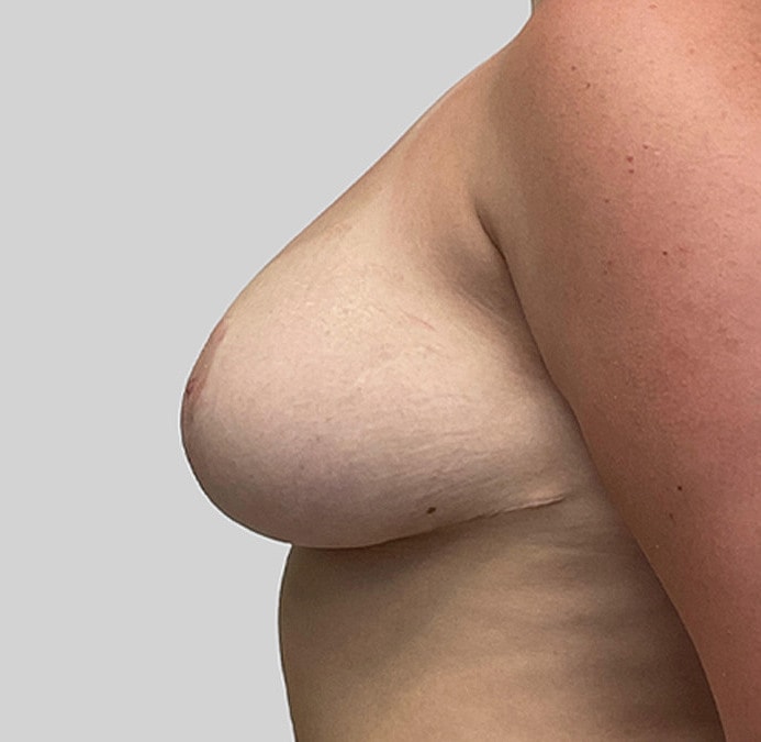 Breast Reduction Before & After
