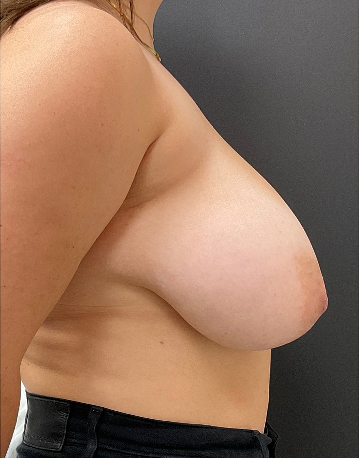 Breast Reduction Before & After